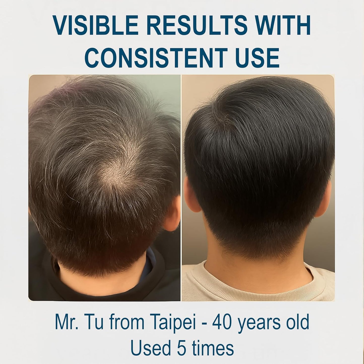 Biochemical Pulse Exosome Hair Growth Serum Care Solution for Hair Density, Reduces Shedding and Promotes a Healthy Scalp | Daily Strengthening Treatment for Weak or Damaged Hair | 30ml